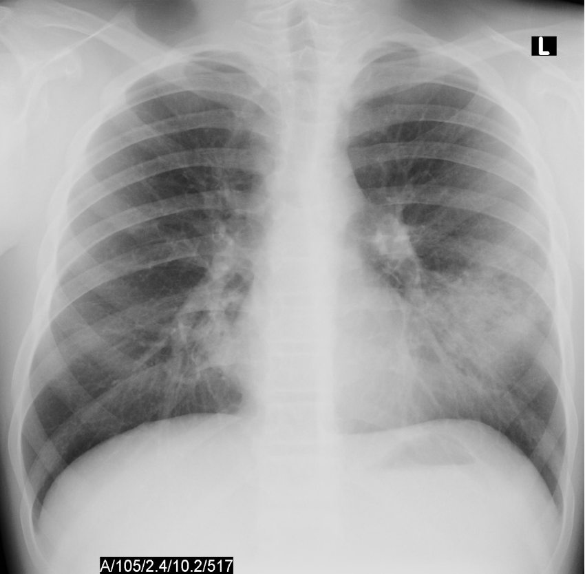X-ray image of lungs with an infection.